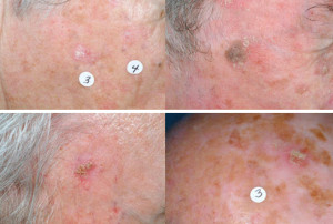 Actinic Keratosis Staten Island precancerous skin spot evaluation by Dr Lederman