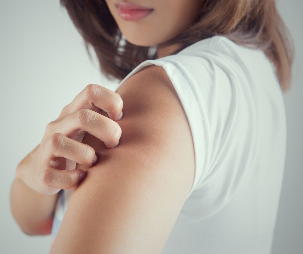 Eczema Treatment Staten Island dry itchy skin medical evaluation by Dr Lederman