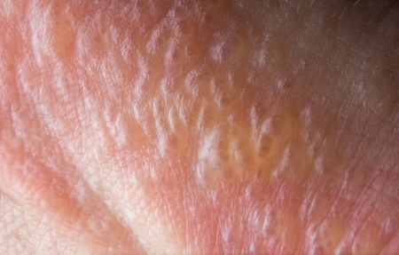 Skin Allergy Treatment Staten Island medical rash evaluation by Dr Lederman
