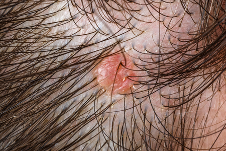 Seborrheic Dermatitis Treatment Staten Island scaling skin medical evaluation by Dr Lederman