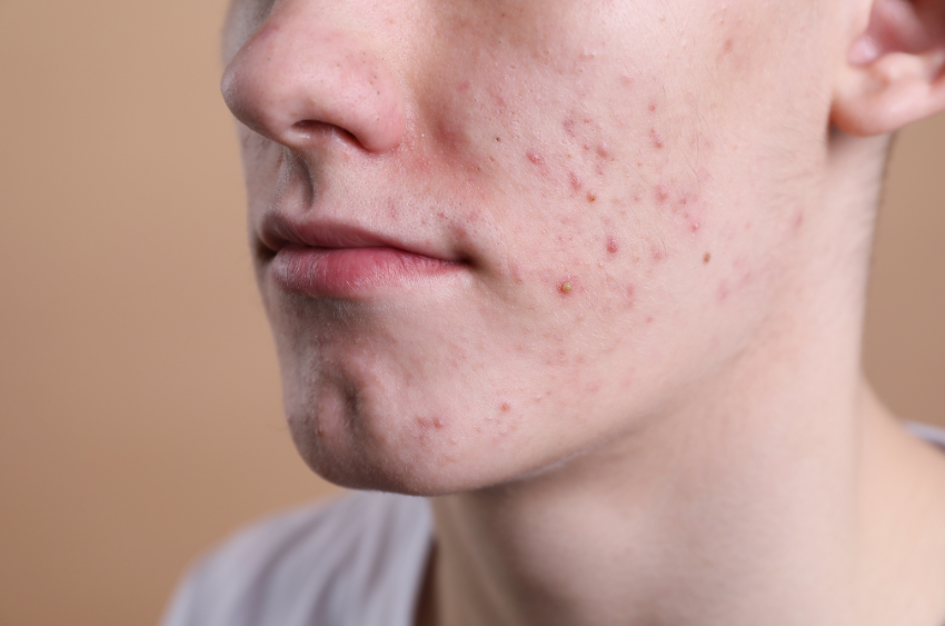 Close-up of a young patient's cheek and jawline with active acne breakouts, pimples, and inflammatory lesions before medical acne treatment in Staten Island.