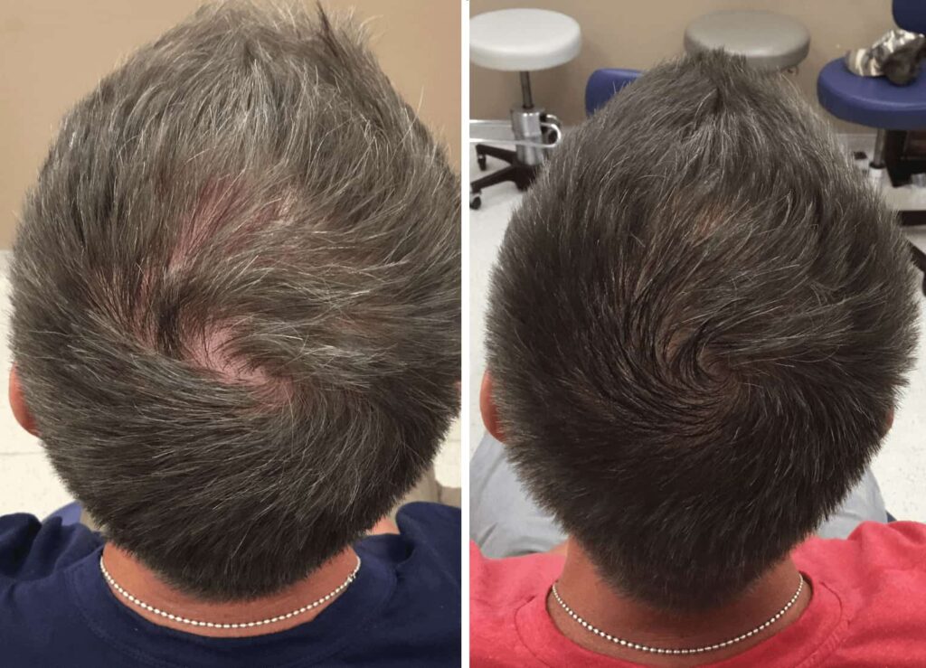 Exosome Hair Restoration Staten Island scalp thinning evaluation by Dr Lederman