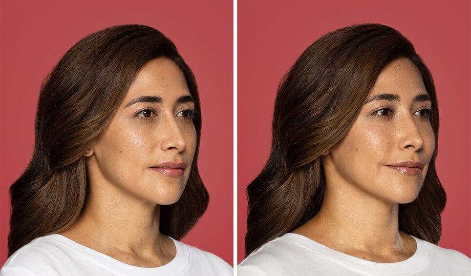 Restylane Contour Staten Island cheek filler evaluation by Dr Lederman