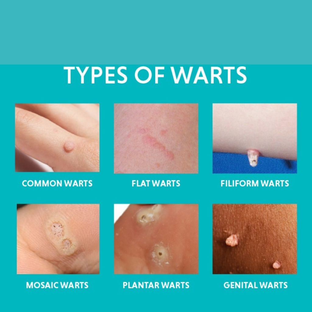 Wart Removal Staten Island benign growth evaluation by Dr Lederman