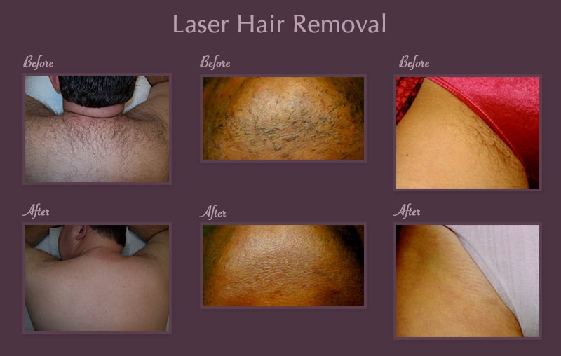 Laser Hair Removal Staten Island cosmetic evaluation by Dr Lederman