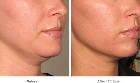 Ultherapy Staten Island ultrasound skin tightening evaluation by Dr Lederman