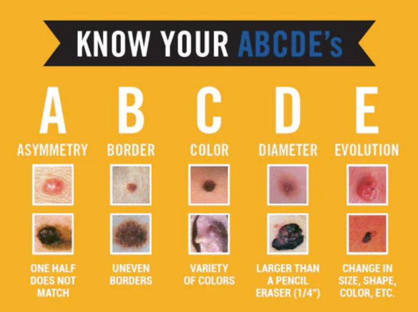 Skin Cancer Treatment Staten Island medical mole evaluation by Dr Lederman