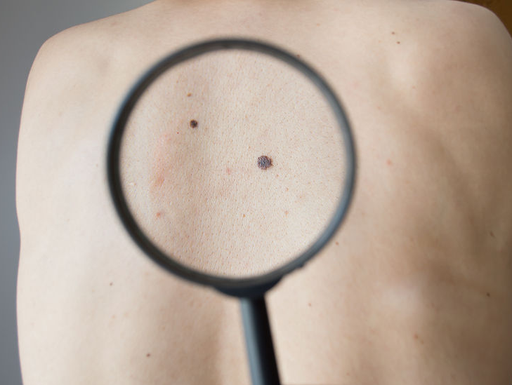Mohs Surgery Staten Island skin cancer removal evaluation by Dr Lederman